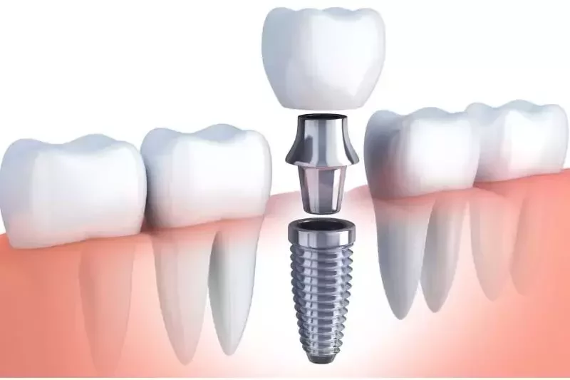 Single tooth implant for natural-looking replacement by Master of Dent specialists
