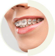 Traditional metal braces for effective teeth alignment and bite correction