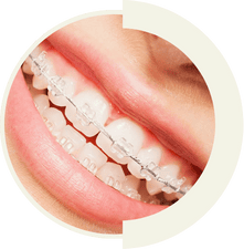Aesthetic ceramic braces for discreet orthodontic treatment