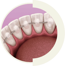 Invisible lingual braces fixed behind teeth for a hidden orthodontic option