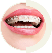 Self-ligating braces providing faster and more comfortable teeth alignment