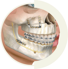 Corrective jaw surgery for facial balance and improved dental function