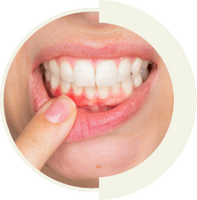 Gummy smile correction for balanced gum-to-tooth ratio at Master of Dent