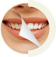 Perfect Hollywood Smile design by Master of Dent cosmetic dentists in Istanbul