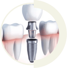 Single tooth implant for natural-looking replacement by Master of Dent specialists