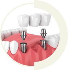 Multiple dental implants to restore missing teeth with full functionality