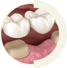 Fixed dental bridge replacing missing teeth at Master of Dent Istanbul