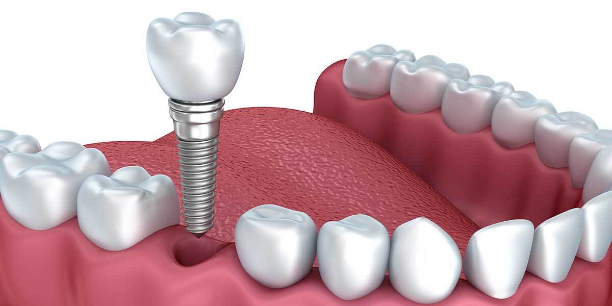 Single tooth implant for natural-looking replacement by Master of Dent specialists