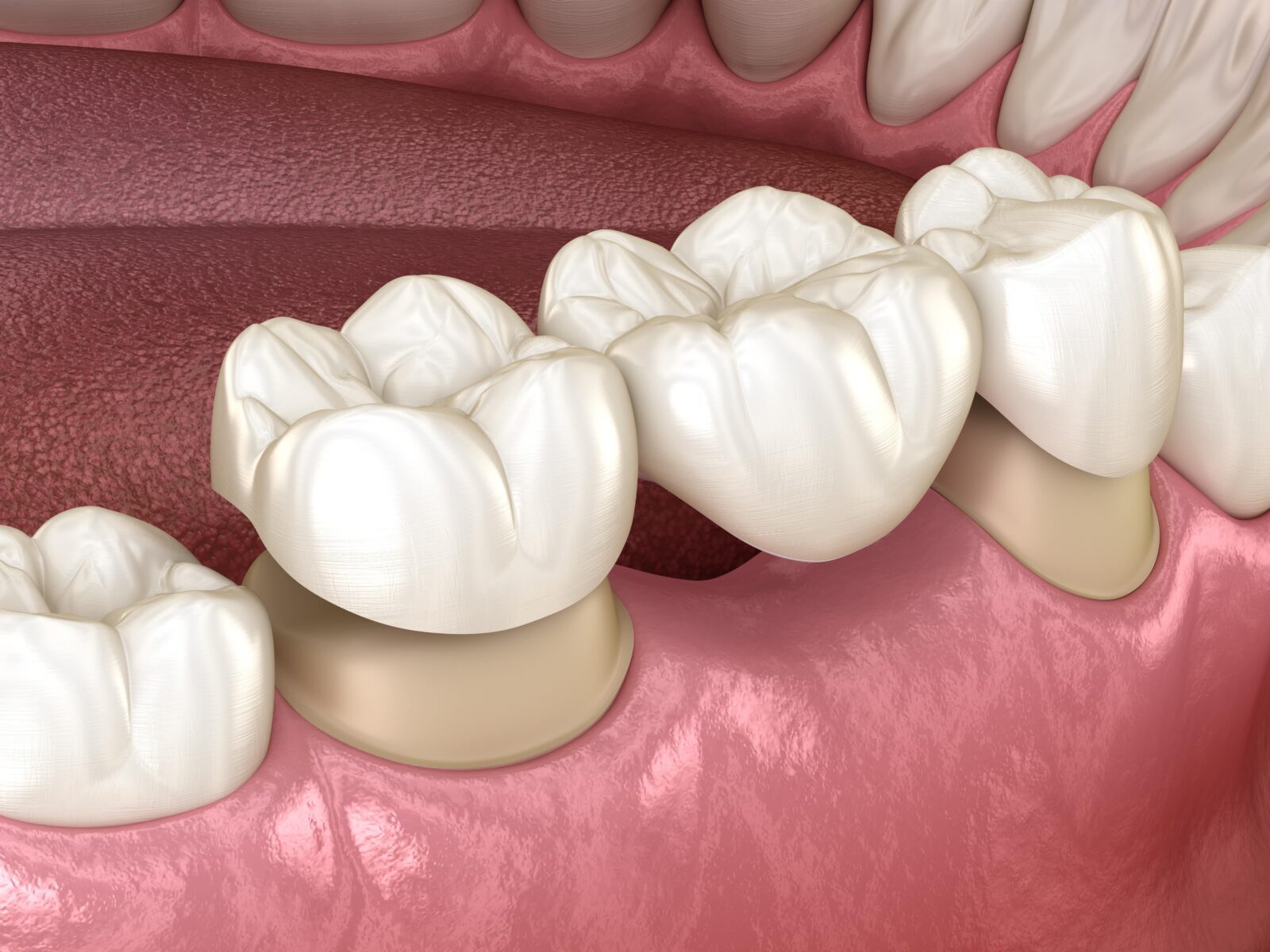 Fixed dental bridge replacing missing teeth at Master of Dent Istanbul
