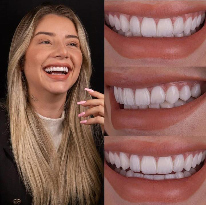 Hollywood Smile