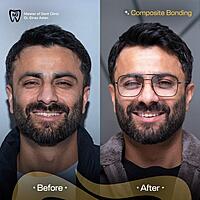 Smile Transformation with Composite Bonding