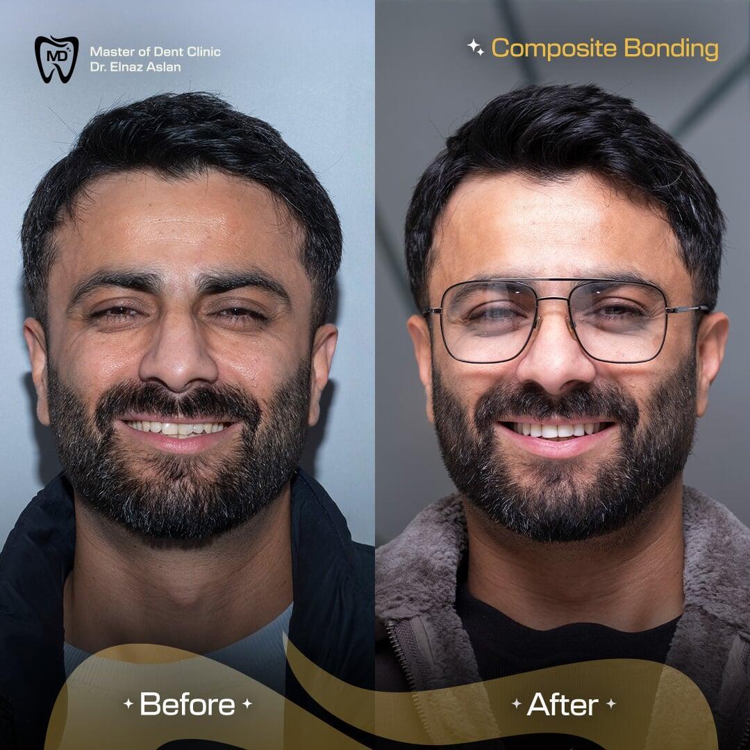 Smile Transformation with Composite Bonding