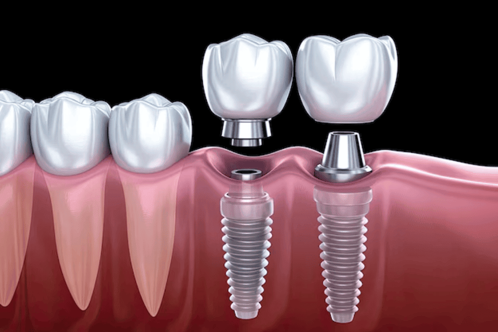Permanent dental implant solutions at Master of Dent Clinic Istanbul