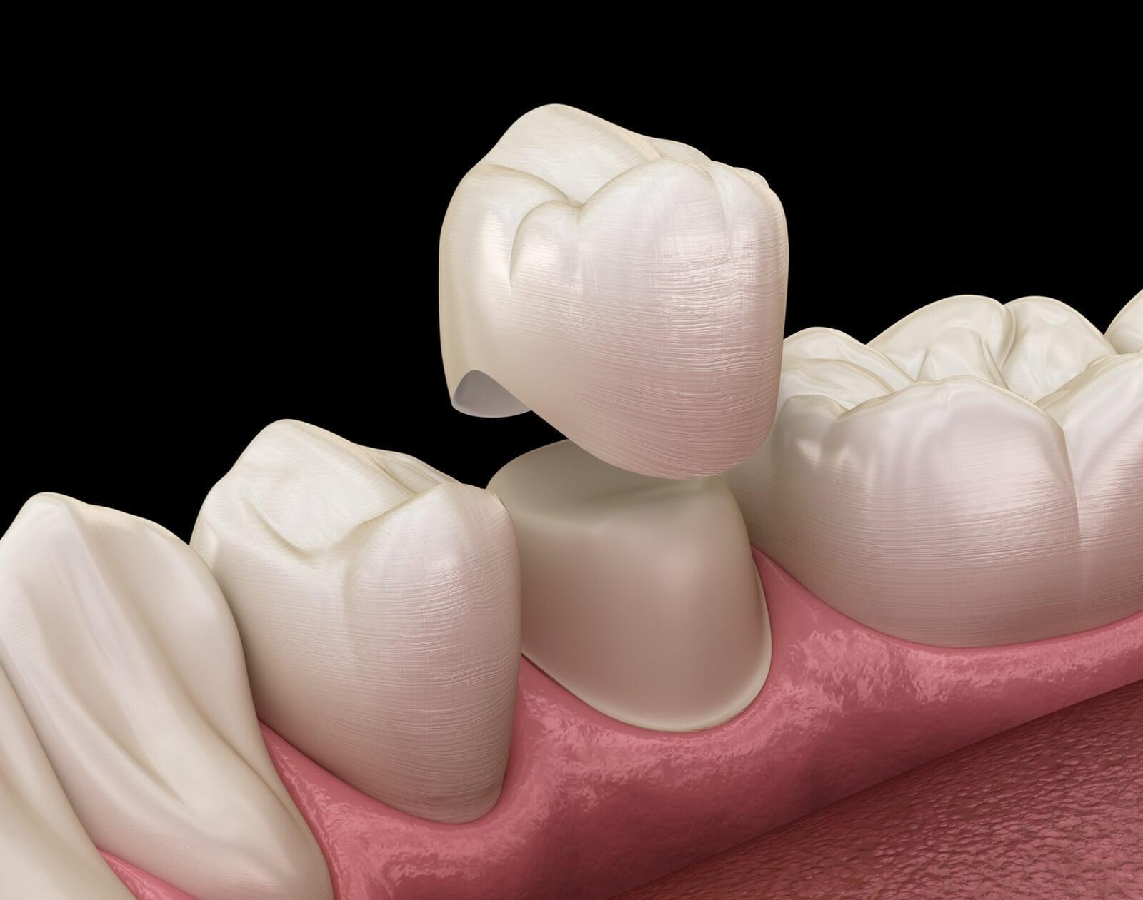 Porcelain and zirconia dental crowns for natural-looking tooth restoration